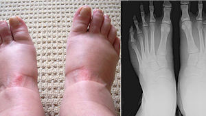 Cierpisz na opuchnięte stopy? Oto 7 poważnych chorób, których to może być objawe